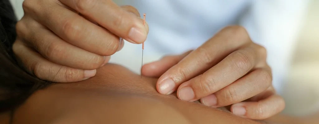 Dry needling